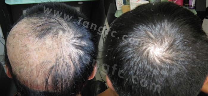 太原織發(fā)補發(fā)哪家做的專業(yè)？