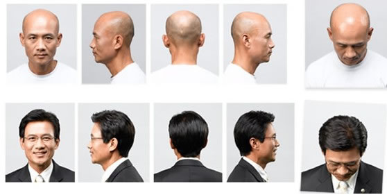 廣州這邊禿頂怎么辦？可以修復(fù)么？