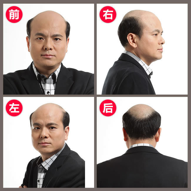 前額兩邊頭發(fā)稀疏怎么辦？看了你就知道怎么解決！