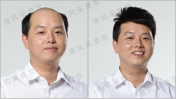 白發(fā)脫發(fā)可不可以進(jìn)行織發(fā)？