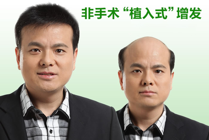 真人假發(fā)織發(fā)補(bǔ)發(fā)有什么優(yōu)勢(shì)？