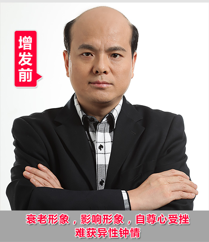 脫發(fā)禿頂?shù)目诵恰鹕剿饺硕ㄖ聘叨思侔l(fā)！