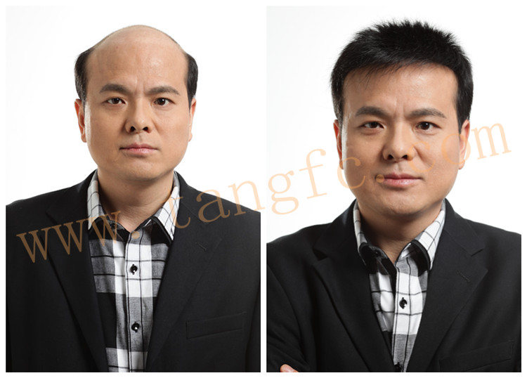 廈門頭發(fā)稀少如何解決？人為什么會脫發(fā)