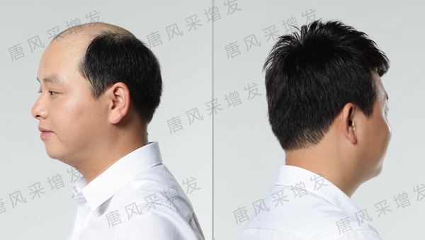 拉薩哪里有織發(fā)補(bǔ)發(fā)？對(duì)禿頂有效嗎？