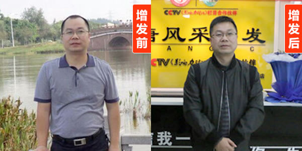 蘭州男士補(bǔ)發(fā)哪里好 蘭州男士補(bǔ)發(fā)哪里好?唐風(fēng)采為“帽子哥”排憂解難