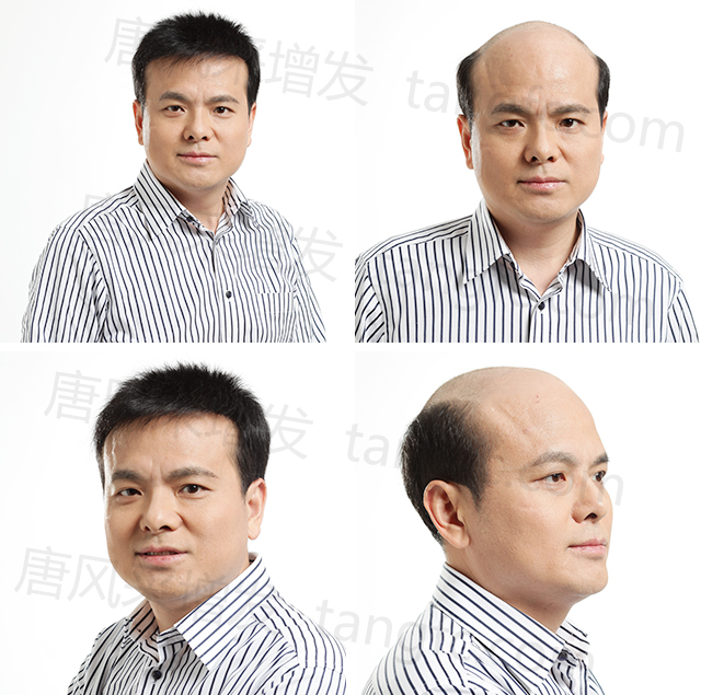 男士假發(fā)定做，讓你擺脫謝頂！