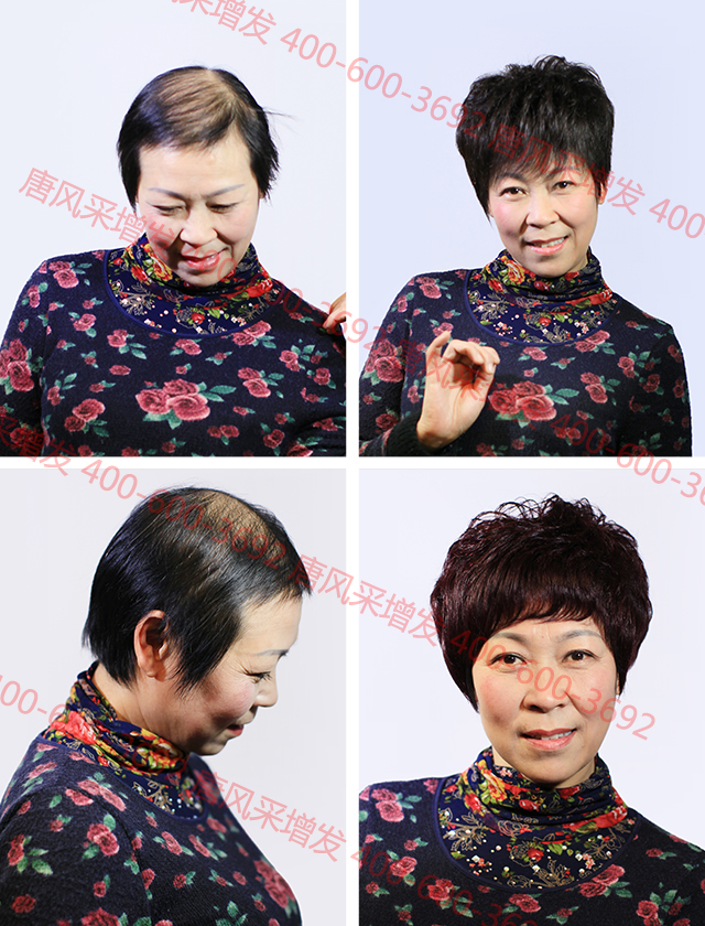 合肥織發(fā)定制解決脫發(fā)，什么品牌值得信賴？