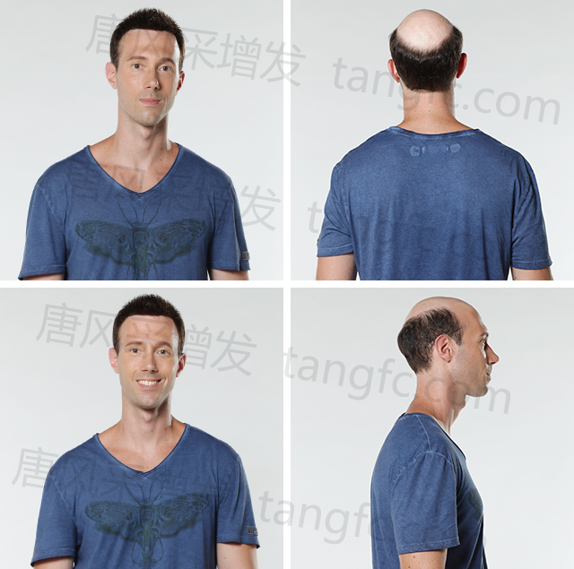 發(fā)際線高的同學，在同齡人中立馬看出年齡差距 