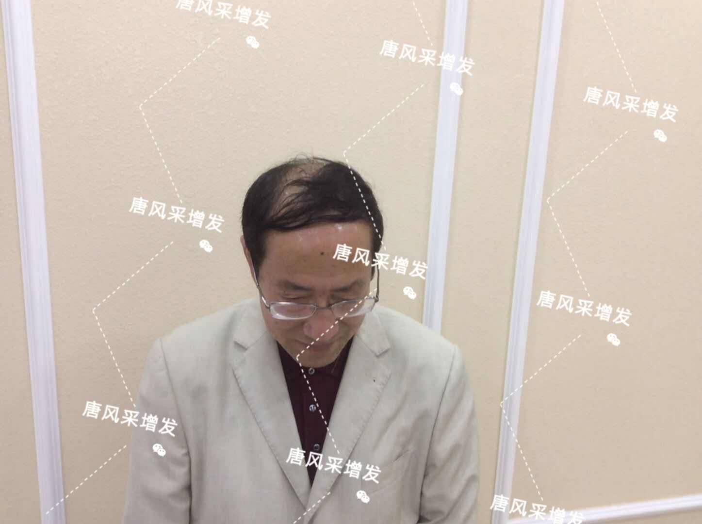 脫發(fā)禿頂成中年男人標(biāo)配？唐風(fēng)采增發(fā)讓您風(fēng)采始終如一