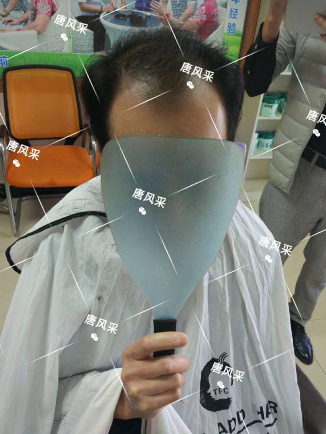 脫發(fā)謝頂壓力大，增發(fā)補發(fā)一身輕！