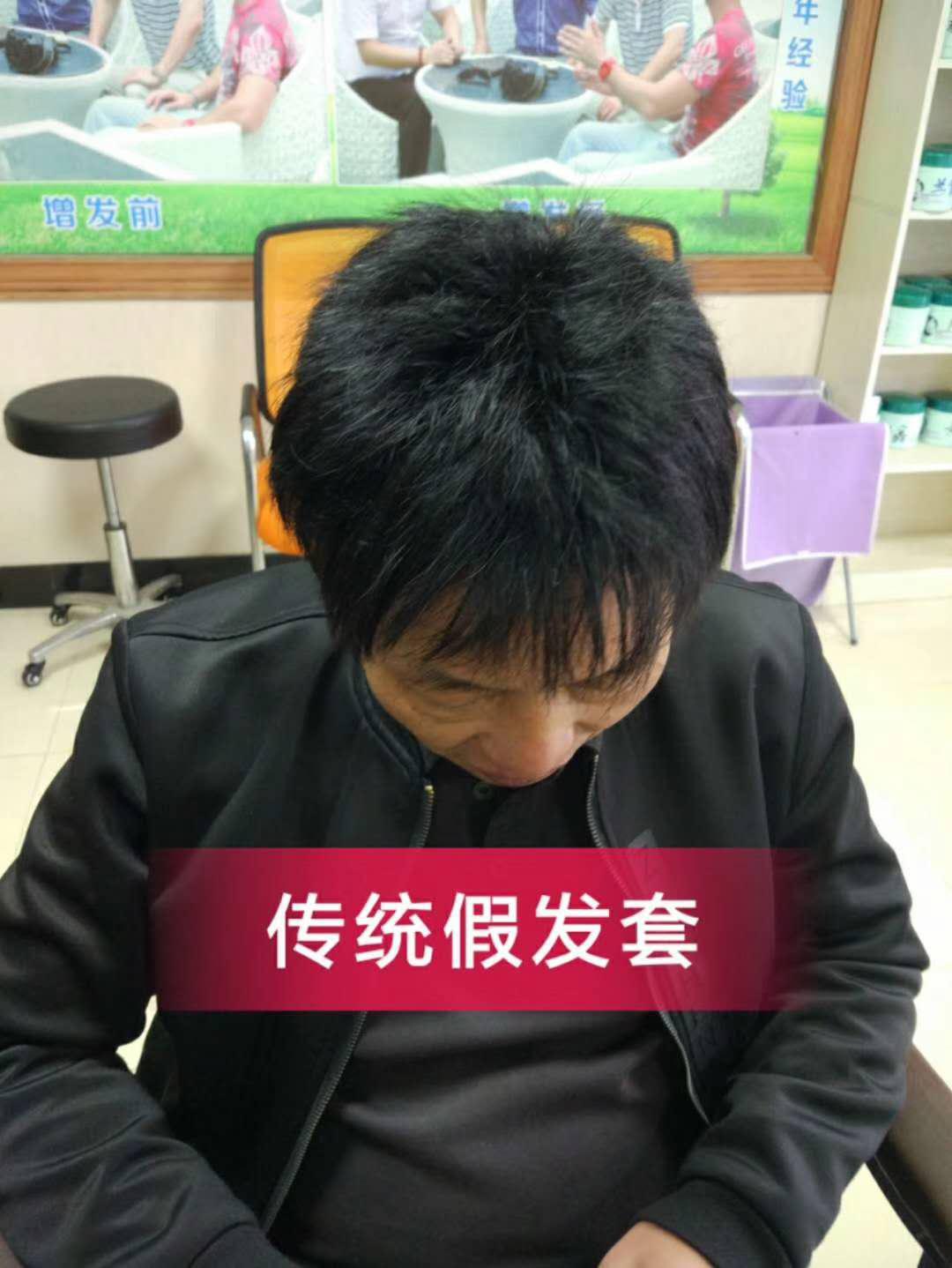 脫發(fā)謝頂壓力大，增發(fā)補發(fā)一身輕！