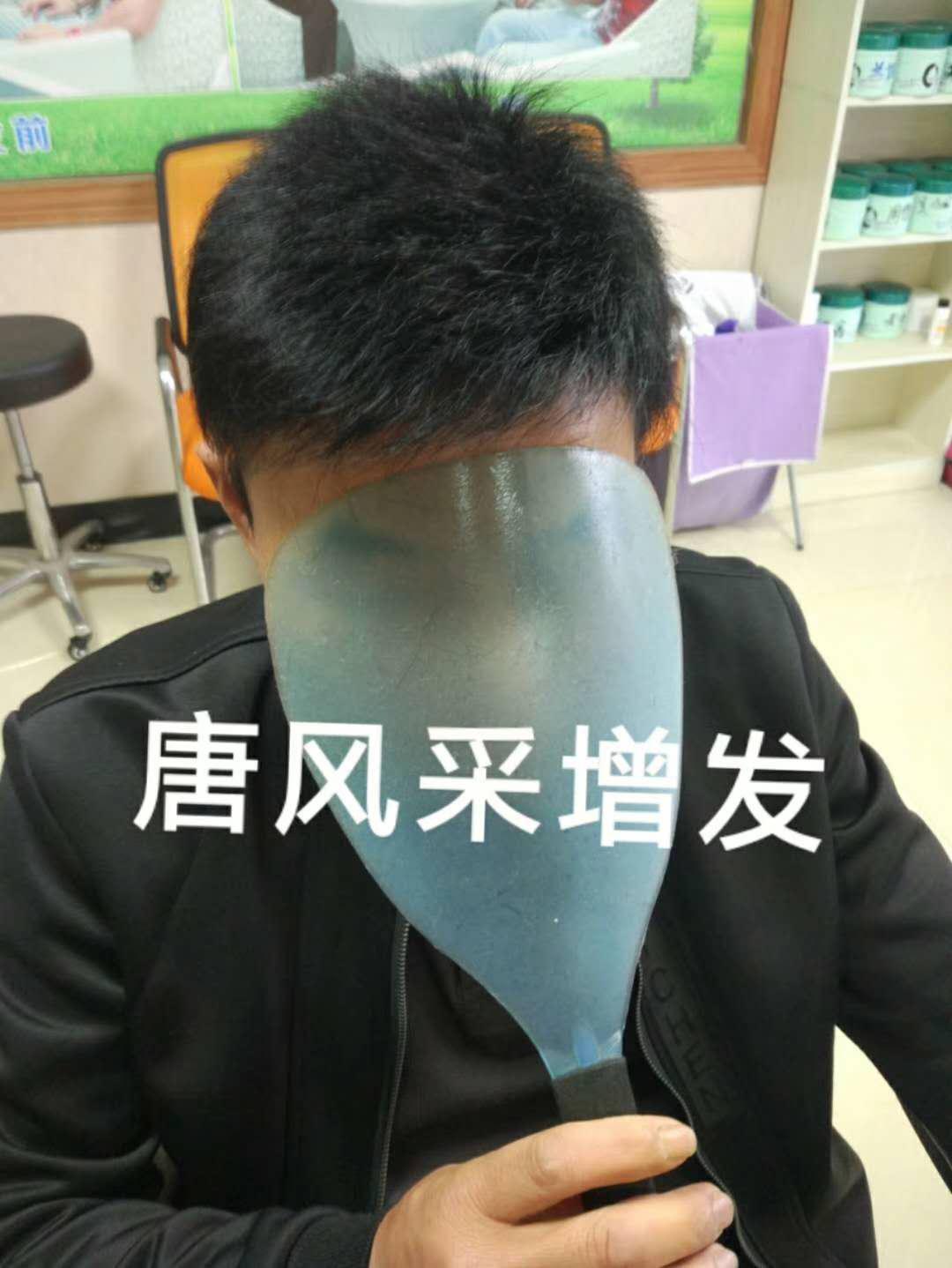 脫發(fā)謝頂壓力大，增發(fā)補發(fā)一身輕！