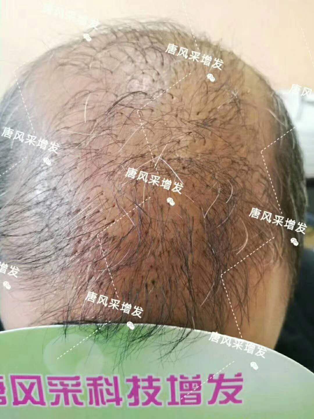 頭發(fā)稀少怎么變密？
