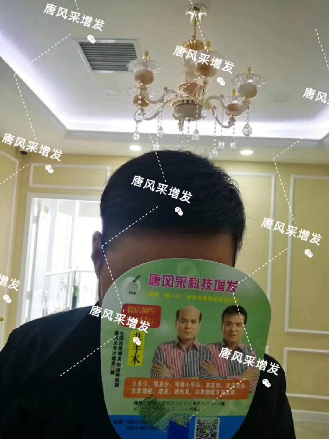 頭發(fā)稀少怎么變密？