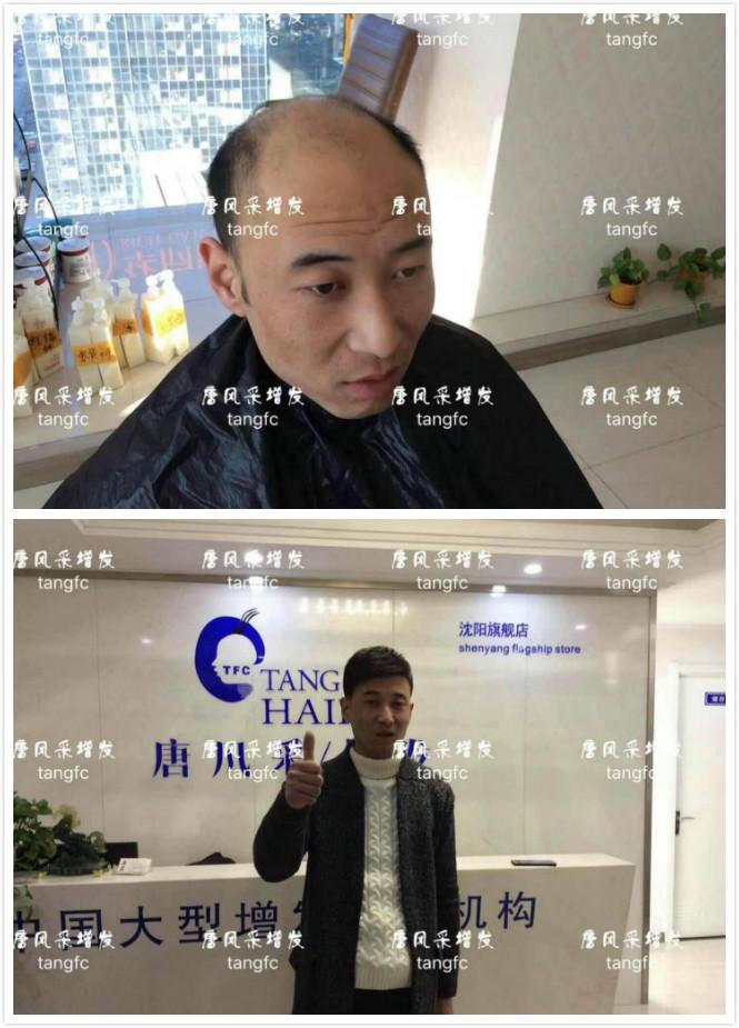 為脫發(fā)者解千愁，增發(fā)前后的驚人對比！