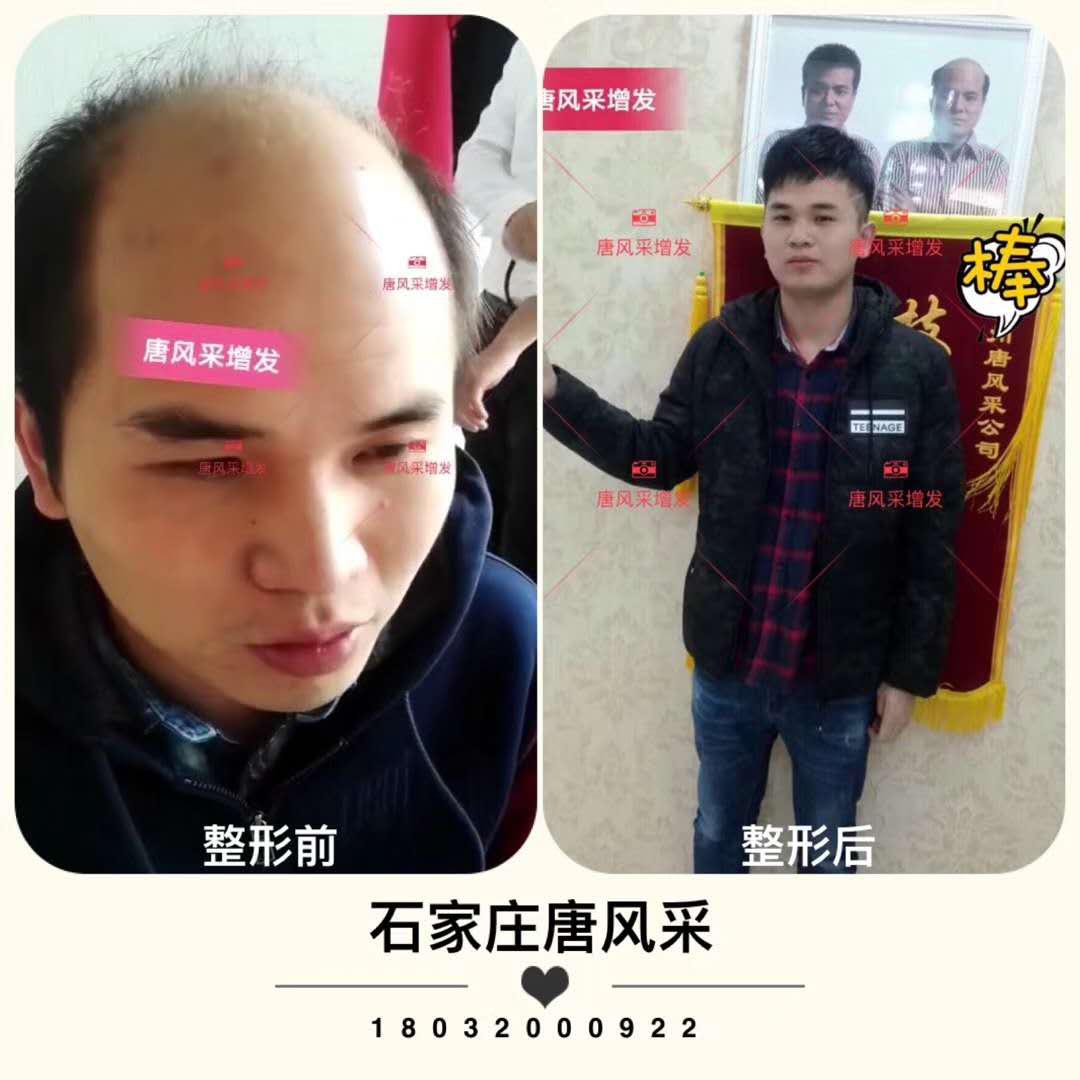 頭發(fā)少怎么辦？