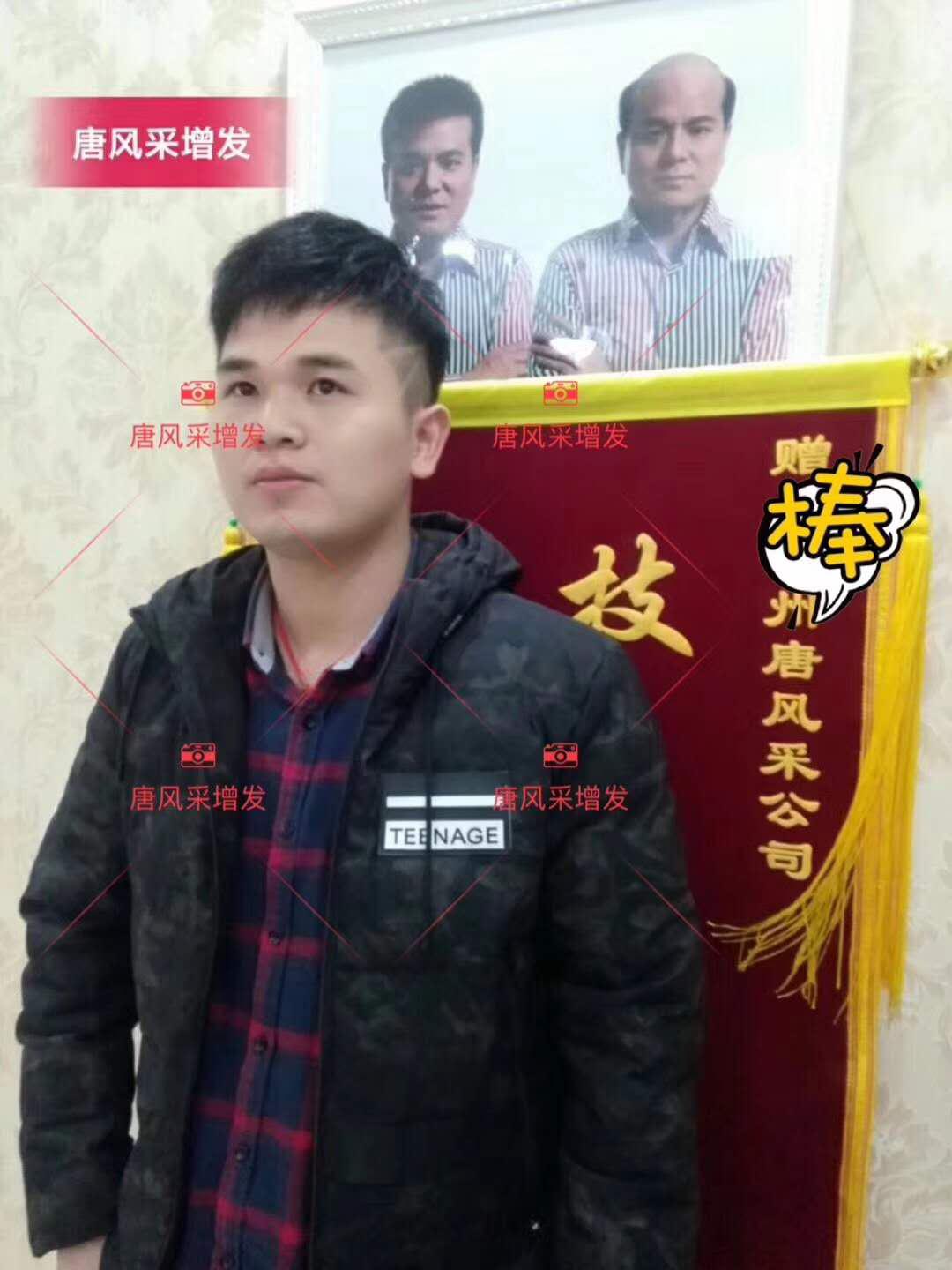 為脫發(fā)者解千愁，增發(fā)前后的驚人對比！