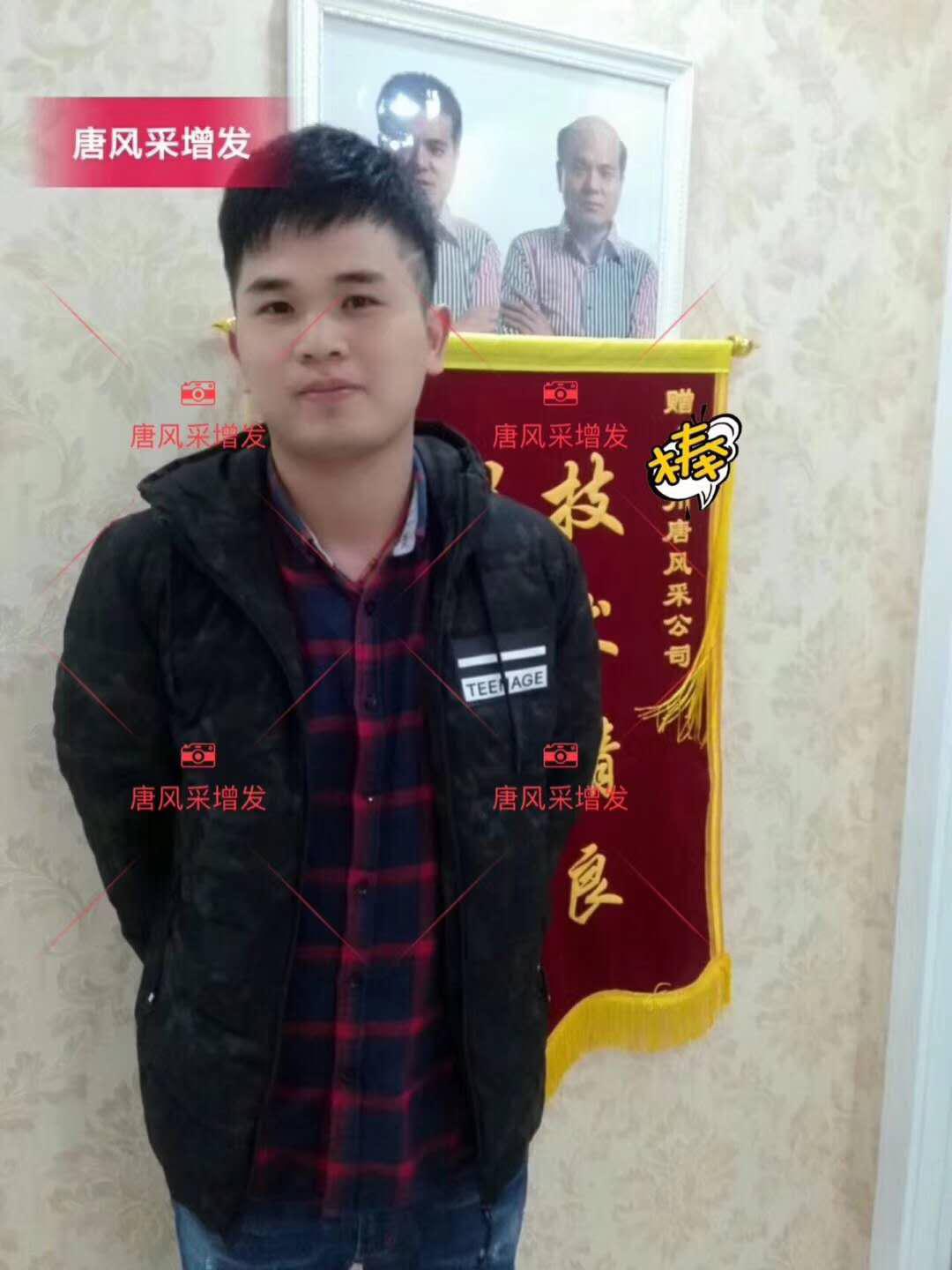 為脫發(fā)者解千愁，增發(fā)前后的驚人對比！