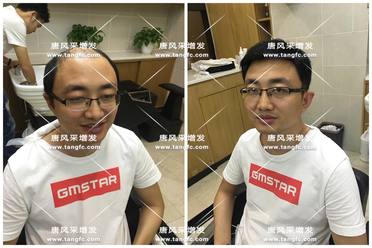 謝頂會坑一輩子？ 我不禁摸了摸自己頭發(fā)