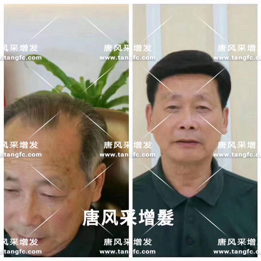謝頂會坑一輩子？ 我不禁摸了摸自己頭發(fā)