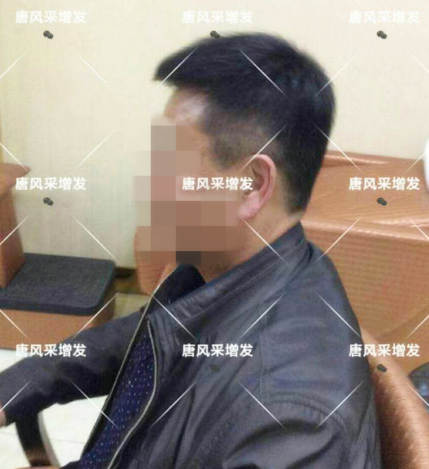 男人脫發(fā)原因多，不能一味怨腎虧！