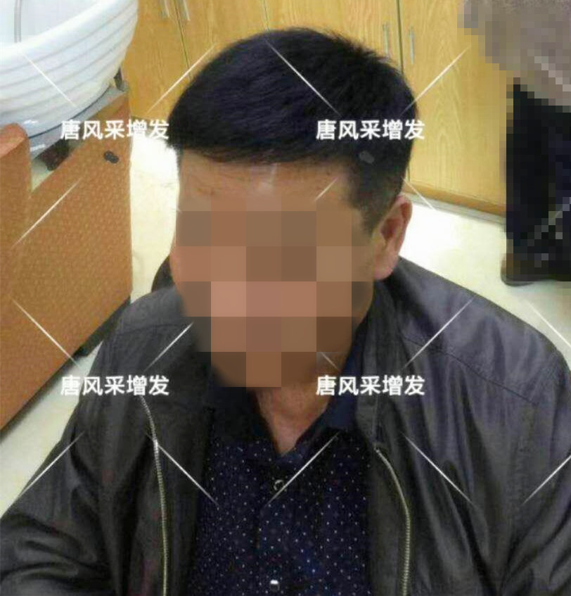 男人脫發(fā)原因多，不能一味怨腎虧！