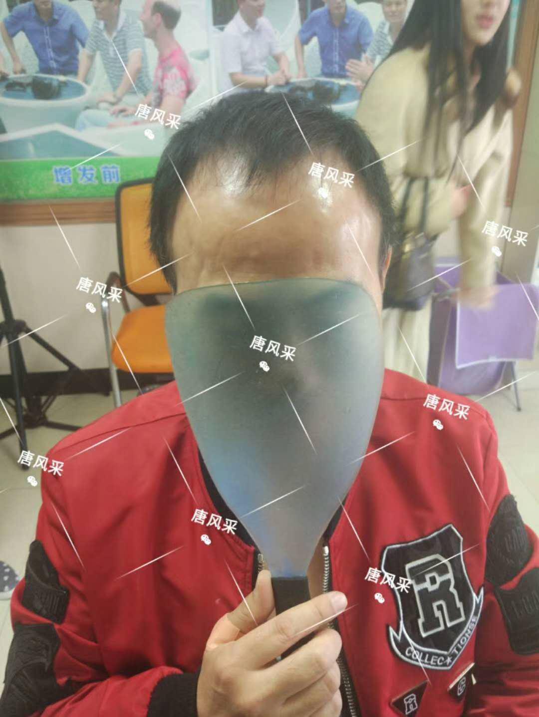男人脫發(fā)原因多，不能一味怨腎虧！