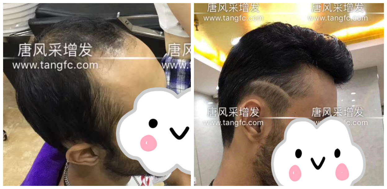 男士假發(fā)容易看出來(lái)嗎？看看做過(guò)頭發(fā)的發(fā)友怎么說(shuō)！