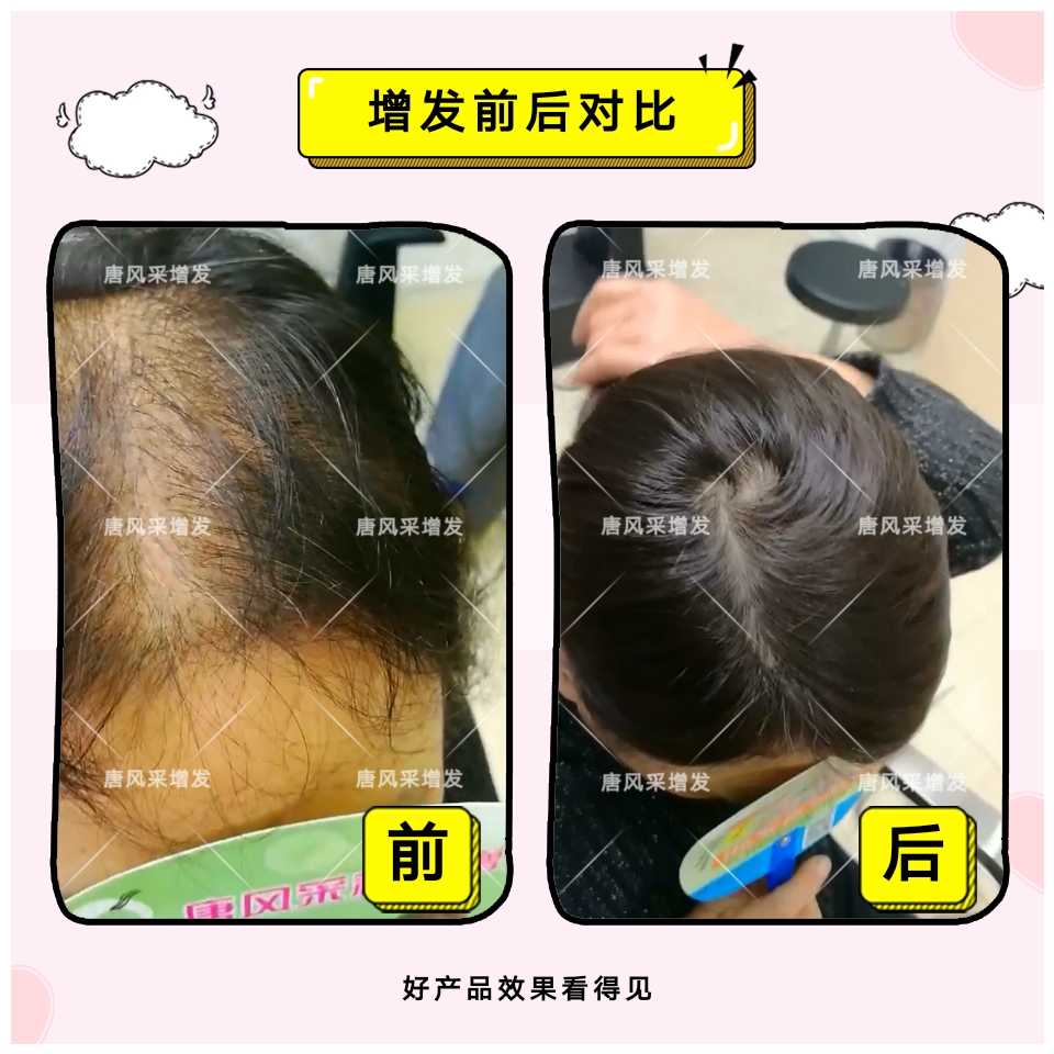 烏魯木齊買隱形假發(fā)哪家好？鳳凰涅槃造就美麗傳說！