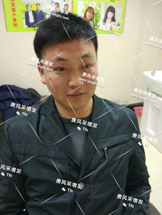 人民公仆也脫發(fā)，廈門夏先生增發(fā)記