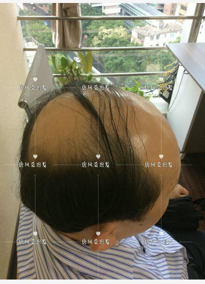存款重要還是頭發(fā)重要？聽聽李先生怎么說！