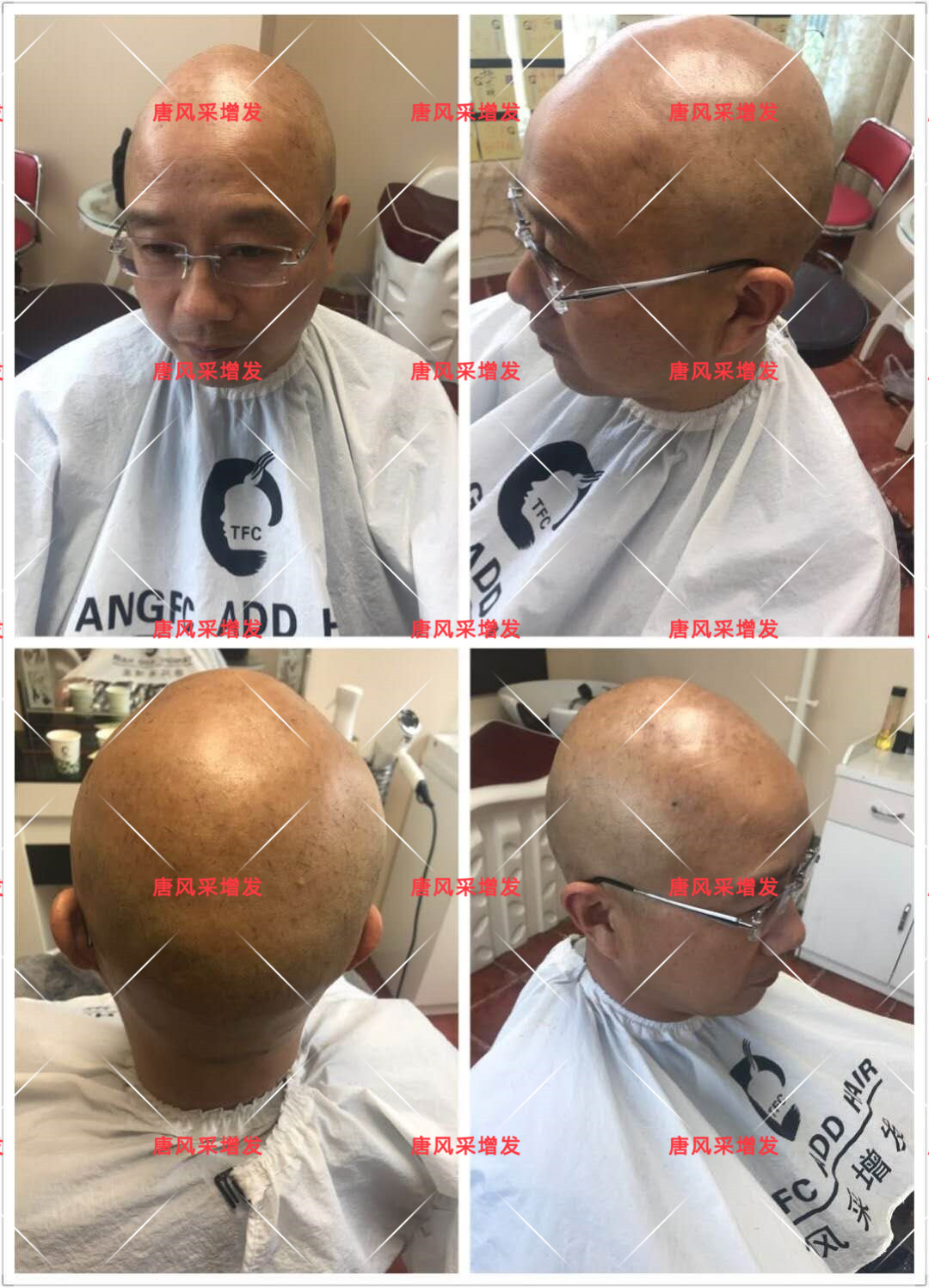 10年脫發(fā)困擾，一次性解決，唐風(fēng)采助力查先生“夢想成真”