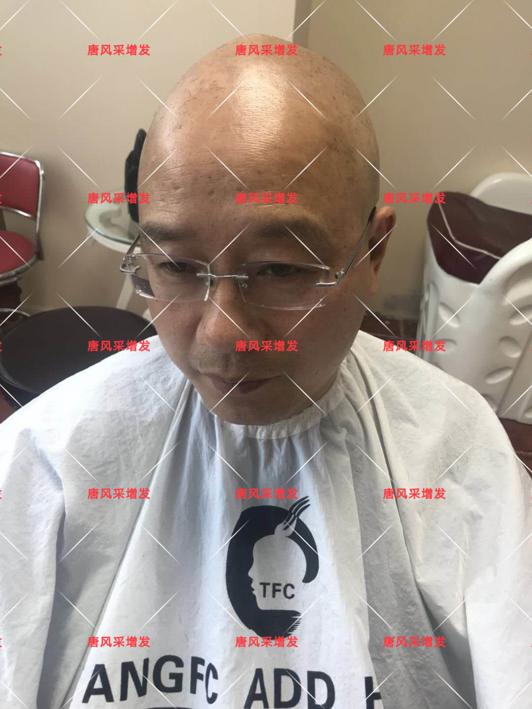 10年脫發(fā)困擾，一次性解決，唐風(fēng)采助力查先生“夢想成真”