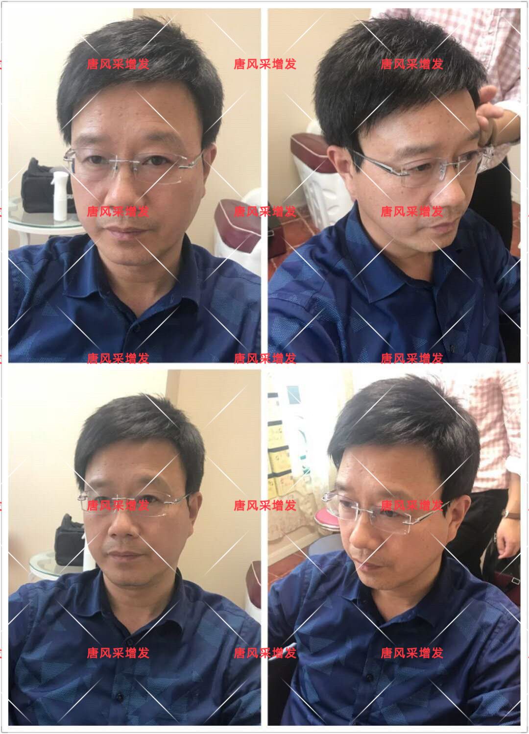 10年脫發(fā)困擾，一次性解決，唐風(fēng)采助力查先生“夢想成真”