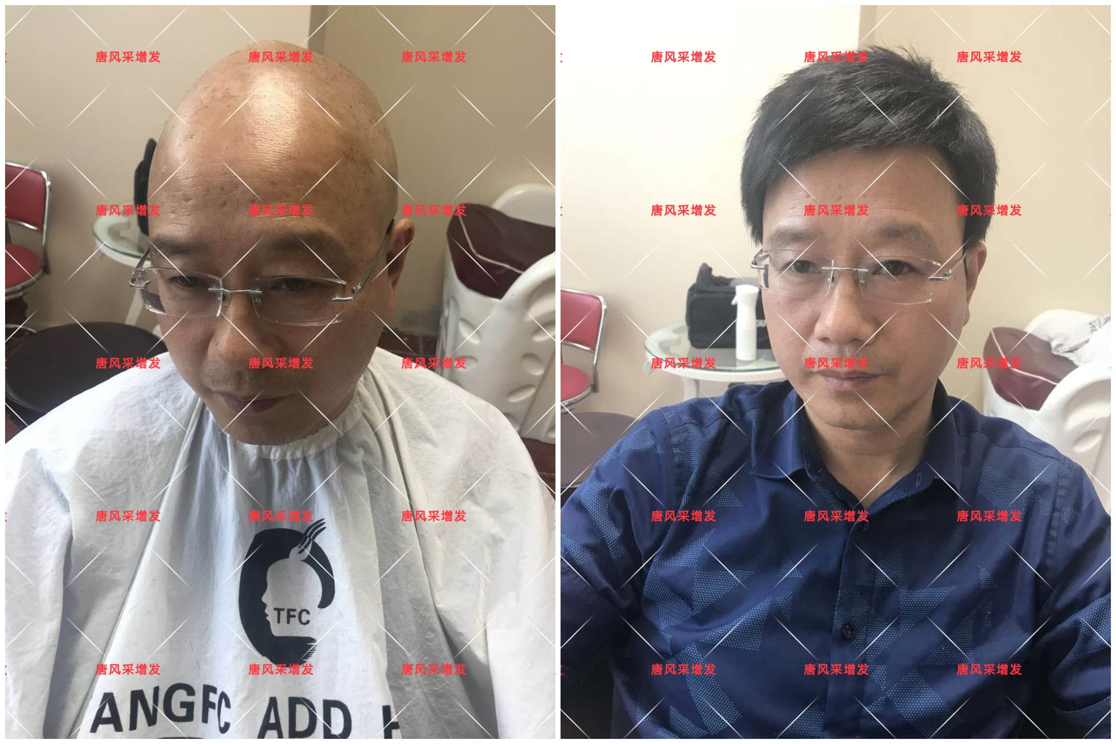 10年脫發(fā)困擾，一次性解決，唐風(fēng)采助力查先生“夢想成真”