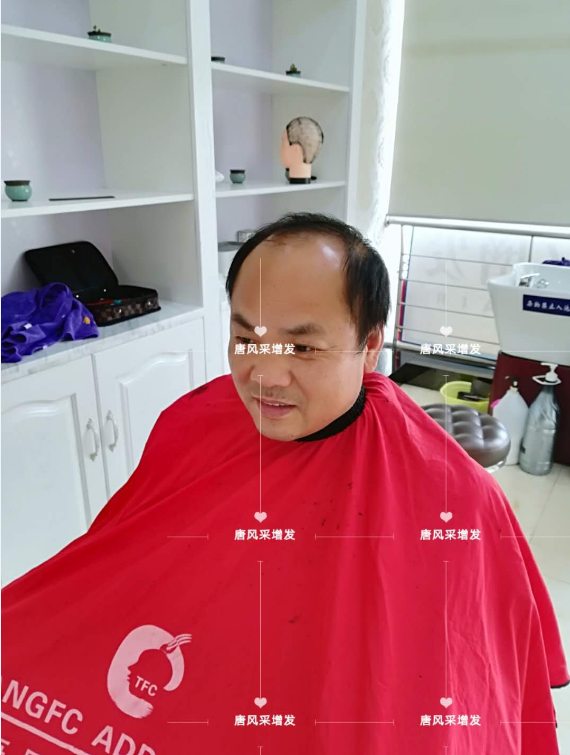 脫發(fā)不分地域，唐風(fēng)采增發(fā)助力北京爺們