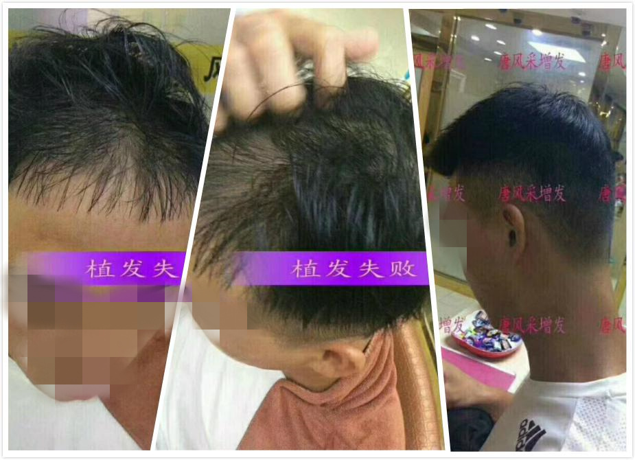 開始脫發(fā)的朋友上醫(yī)院，見到專家后他徹底絕望了！
