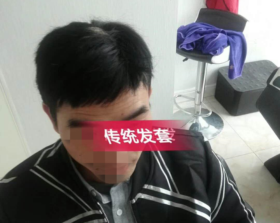 開始脫發(fā)的朋友上醫(yī)院，見到專家后他徹底絕望了！