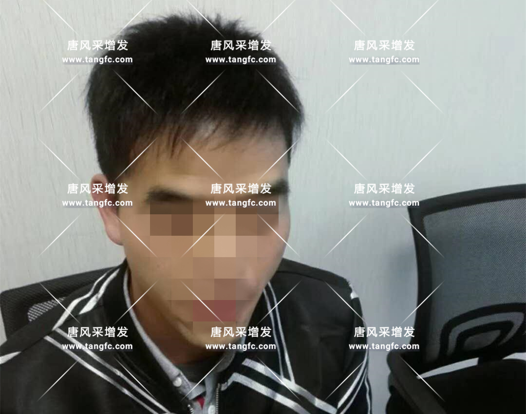 開始脫發(fā)的朋友上醫(yī)院，見到專家后他徹底絕望了！
