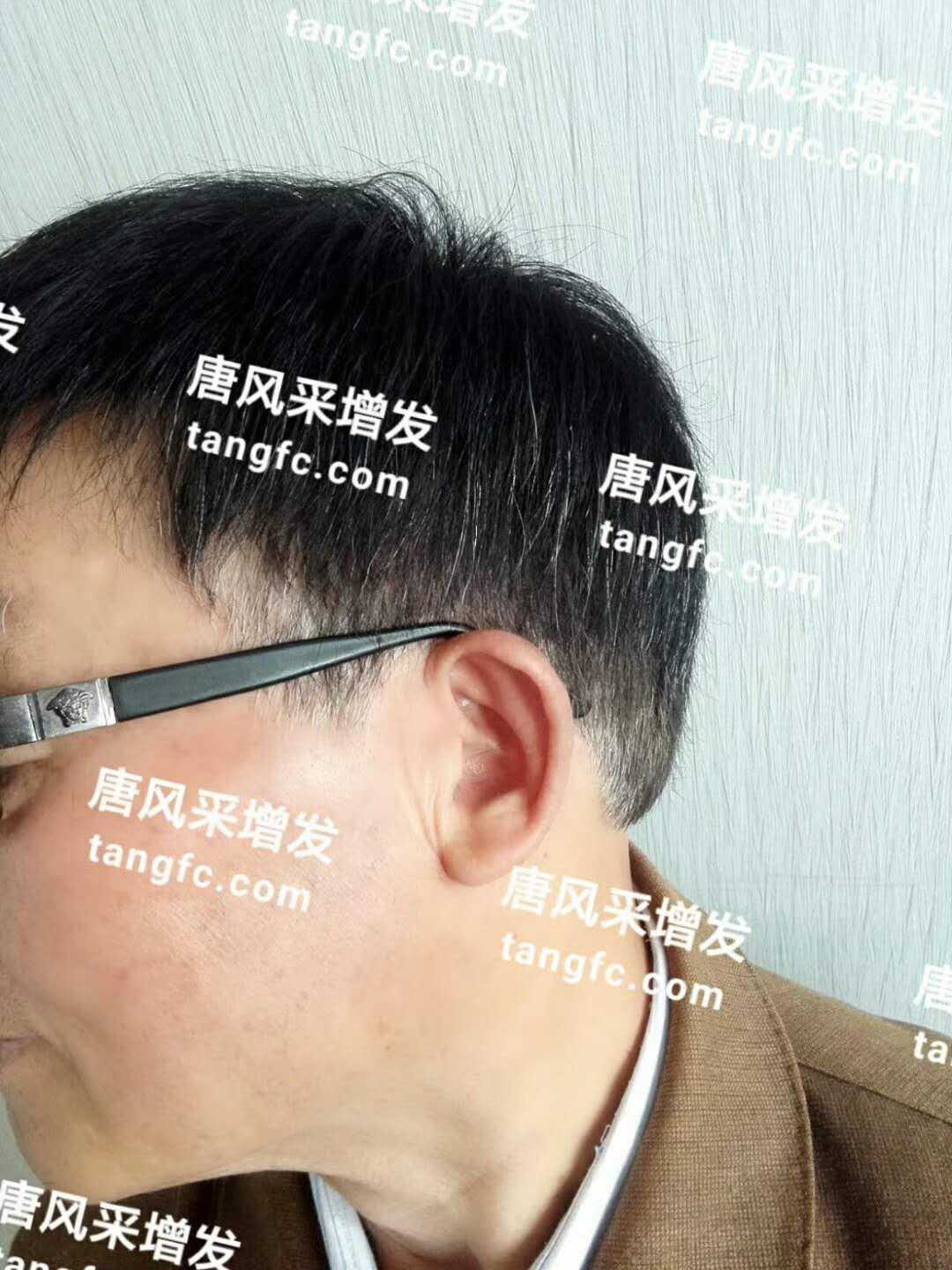 開始脫發(fā)的朋友上醫(yī)院，見到專家后他徹底絕望了！