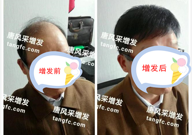 開始脫發(fā)的朋友上醫(yī)院，見到專家后他徹底絕望了！