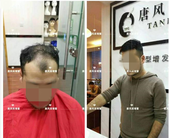 謝頂是顏值也拯救不了的尷尬！