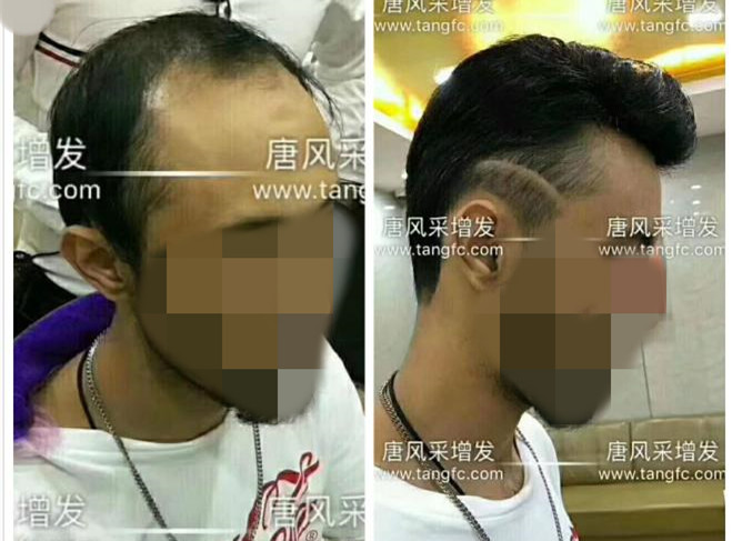 謝頂是顏值也拯救不了的尷尬！