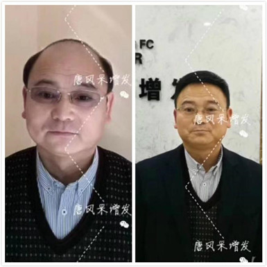 如何避免成為一個(gè)脫發(fā)的中年猥瑣男人？