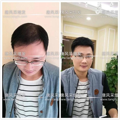 如何避免成為一個(gè)脫發(fā)的中年猥瑣男人？