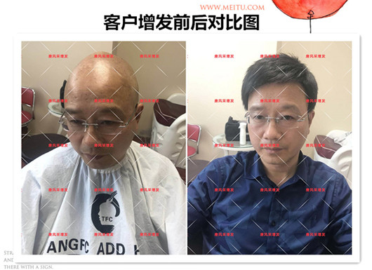 雙節(jié)同慶，給脫發(fā)的父親什么禮物，讓父親“年輕10歲”的神