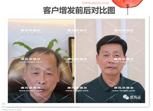 雙節(jié)同慶，給脫發(fā)的父親什么禮物，讓父親“年輕10歲”的神