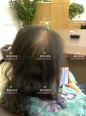 頭發(fā)稀少了，我該拿什么來拯救你？