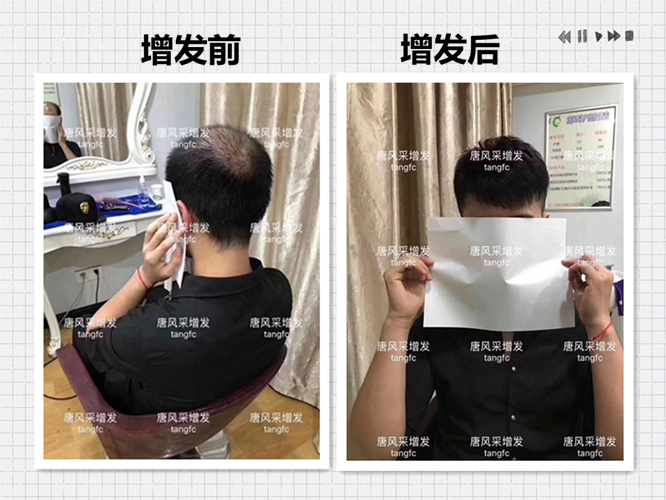 西寧補(bǔ)發(fā)哪里好誰(shuí)知道？ 90后脫發(fā)了想做補(bǔ)發(fā)！