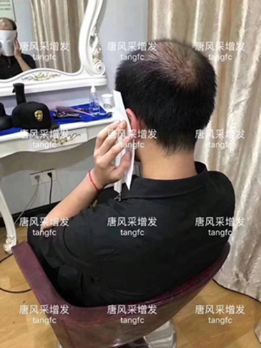 西寧補(bǔ)發(fā)哪里好誰(shuí)知道？ 90后脫發(fā)了想做補(bǔ)發(fā)！